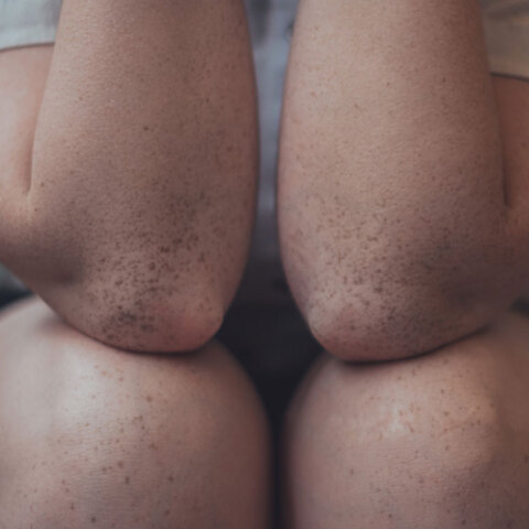 Παιδί με λυγισμένα γόνατα