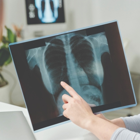 Καρκίνος του Πνεύμονα: Οι νέες θεραπευτικές προσεγγίσεις