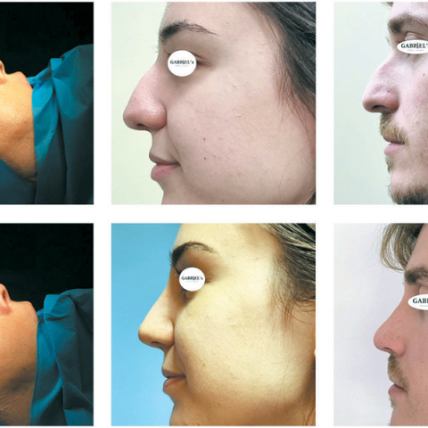 Αισθητική και λειτουργική αναβάθμιση της μύτης με τη νέα κλειστή ρινοπλαστική