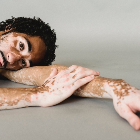 Τι είναι οι αυτοάνοσες ασθένειες και γιατί ακούμε γι’ αυτές όλο και περισσότερο