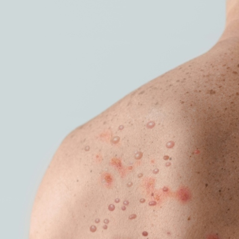 Νέα επιδημία mpox: Θα κάνουμε τα ίδια λάθη;   