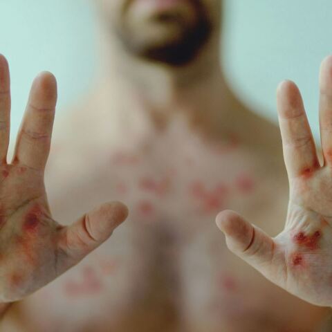 Ευλογιά των Πιθήκων: Ο ΠΟΥ ξεκαθαρίζει πως η mpox δεν είναι η νέα covid