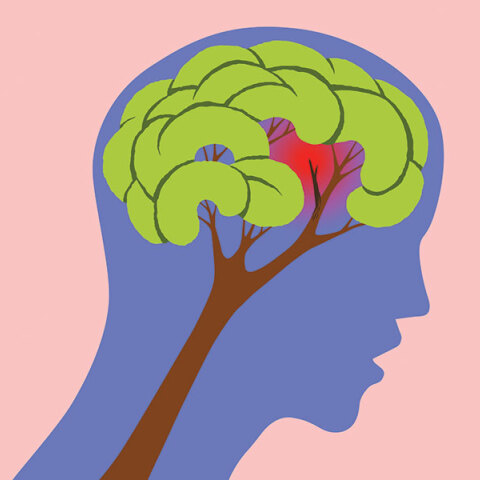 Μεθεόρτια εγκεφαλικού