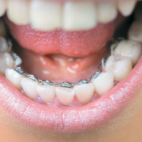 Νέες εξελίξεις στην ορθοδοντική ενηλίκων