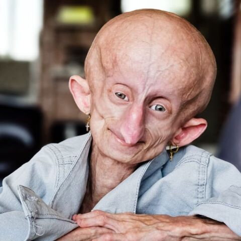 Πέθανε η 19χρονη που έπασχε από πρόωρη γήρανση 