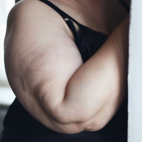 Η παχυσαρκία στην ηλικία 35-65 ετών αυξάνει τον κίνδυνο εμφάνισης άνοιας κατά περίπου 30%