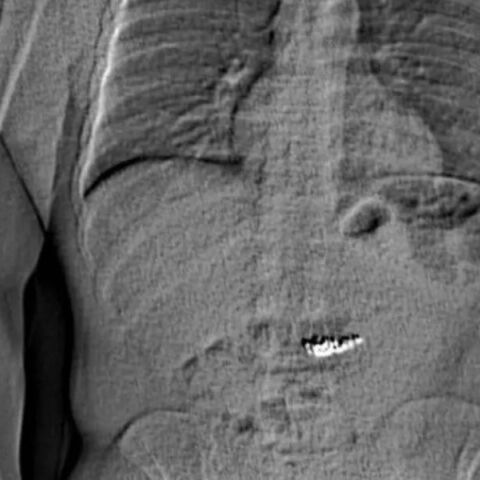 ΗΠΑ: Άνδρας κατάπιε κλεμμένα σκουλαρίκια Tiffany αξίας 769.500 δολαρίων λίγο πριν τη σύλληψή του - Εκκρεμούν 48 εντάλματα σύλληψης εναντίον του