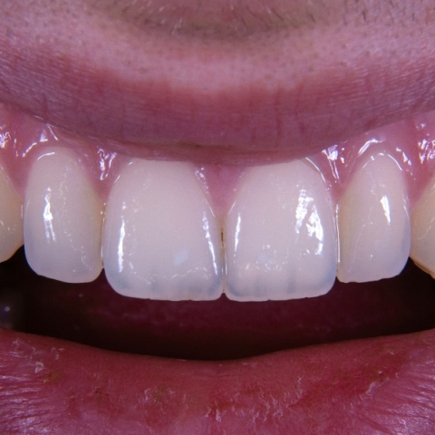 Τι είναι το χαμόγελο Ozempic 