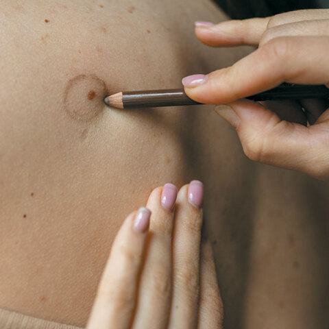 Χαρτογράφηση σπίλων: Προστατεύοντας το δέρμα μας