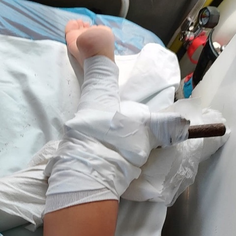 Τραυματισμός - σοκ για 26χρονη στη Χαλκιδική - Ομπρέλα θαλάσσης καρφώθηκε στο πόδι της