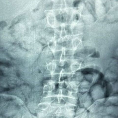 Ελ. Βενιζέλος: Συνελήφθη άνδρας που είχε καταπιεί 100 συσκευασίες κοκαΐνης