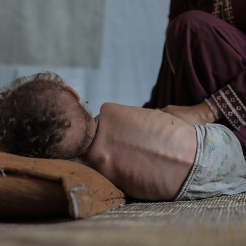 Μωρό αδυνατισμένο σε κρεβάτι στη Γάζα