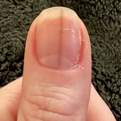 Γυναίκα ανάρτησε στο Reddit φωτογραφία με σκούρα γραμμή στο νύχι της - Οι χρήστες προειδοποίησαν ότι μπορεί να σχετίζεται με μελάνωμα.