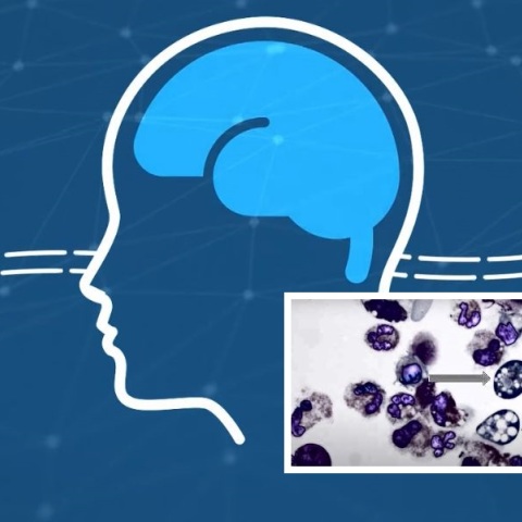 Άνδρας στο Μιζούρι πέθανε από σπάνια λοίμωξη που προκαλεί η αμοιβάδα Naegleria fowleri, η οποία εισέρχεται στον οργανισμό από τη μύτη.