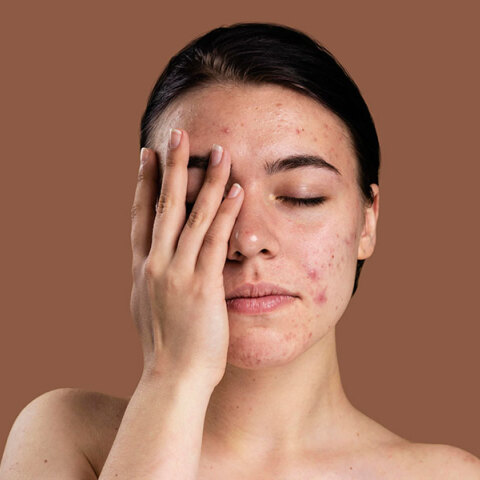 Ακμή: Γιατί παρουσιάζει έξαρση το καλοκαίρι;