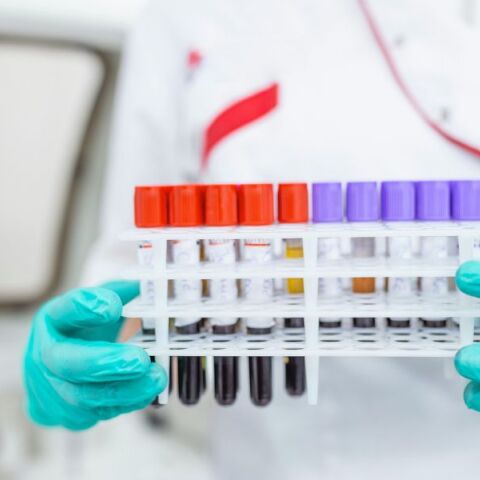 Βρετανοί επιστήμονες ανέπτυξαν την πρώτη ακριβή εξέταση αίματος για το σύνδρομο χρόνιας κόπωσης, προσφέροντας ελπίδα για έγκαιρη διάγνωση.