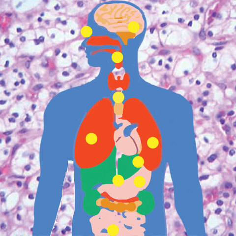 VHL σύνδρομο: Πώς είναι να ζεις με ένα σπάνιο νόσημα στην Ελλάδα του σήμερα