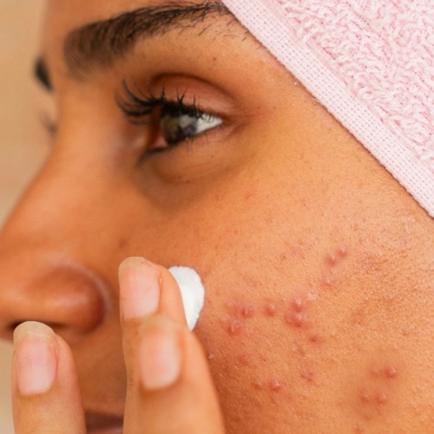 Κάποια σπυράκια απλώς δεν τα ακουμπάμε! 