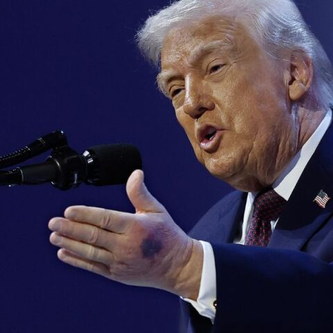 Ο Ντόναλντ Τραμπ απέδωσε τη νέα μελανιά στο χέρι του σε χτύπημα σε τραπέζι στο Νταβός - Ο Λευκός Οίκος επιβεβαιώνει το περιστατικό.