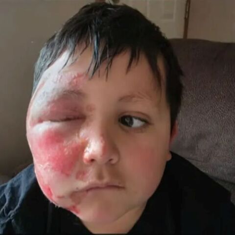 O 9χρονος που υπέστη σοβαρά εγκαύματα δοκιμάζοντας επικίνδυνο διαδικτυακό trend