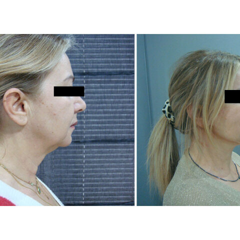 Deep Plane Face & Neck Lift