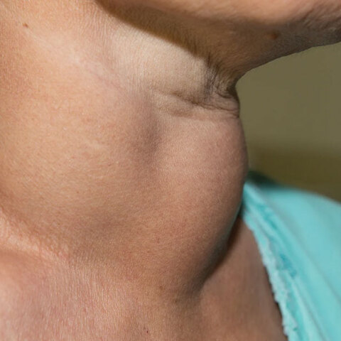 Βρογχοκήλη