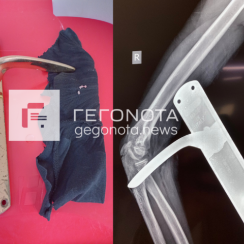 Πόμολο καρφώθηκε στο χέρι μαθητή Δημοτικού