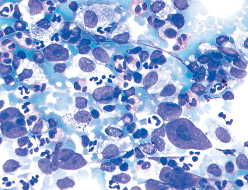 μη-Hodgkin λέμφωμα (ΜΗΛ)