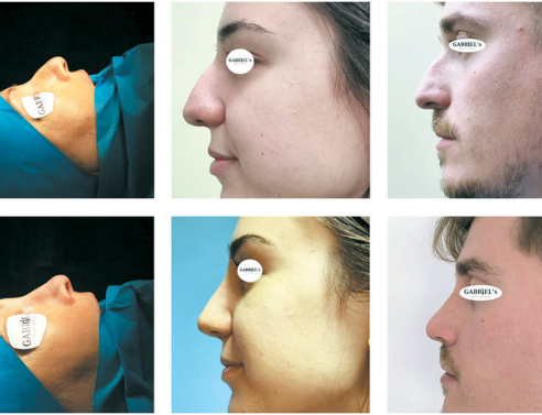 Αισθητική και λειτουργική αναβάθμιση της μύτης με τη νέα κλειστή ρινοπλαστική