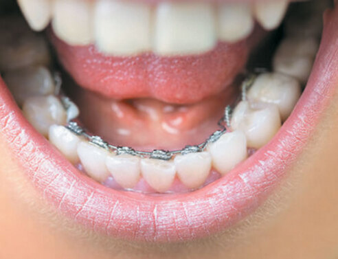 Νέες εξελίξεις στην ορθοδοντική ενηλίκων