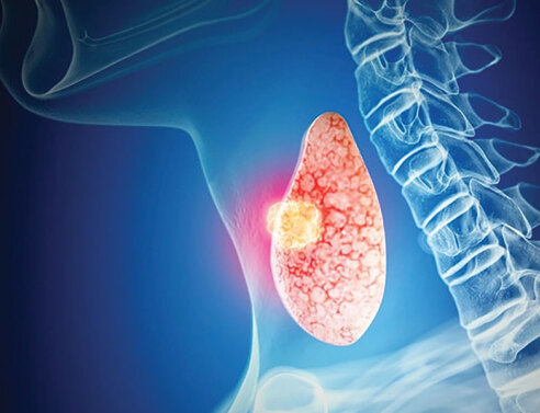 Καρκίνος θυρεοειδούς: Πώς αντιμετωπίζεται και πώς εξελίσσεται;