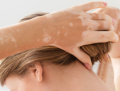 Λεύκη: Τι την προκαλεί και πώς μπορεί να βοηθήσει ο δερματολόγος