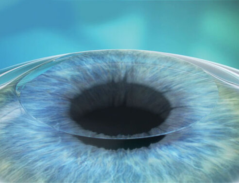 Διόρθωση Μυωπίας, Υπερμετρωπίας, Αστιγματισμού, Αντιμετώπιση πρεσβυωπίας