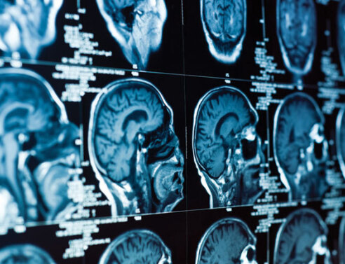 Πολλαπλή σκλήρυνση