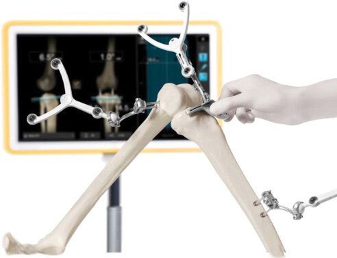 Προηγμένη τεχνολογία ρομποτικής πλοήγησης στην Ευρωκλινική Αθηνών