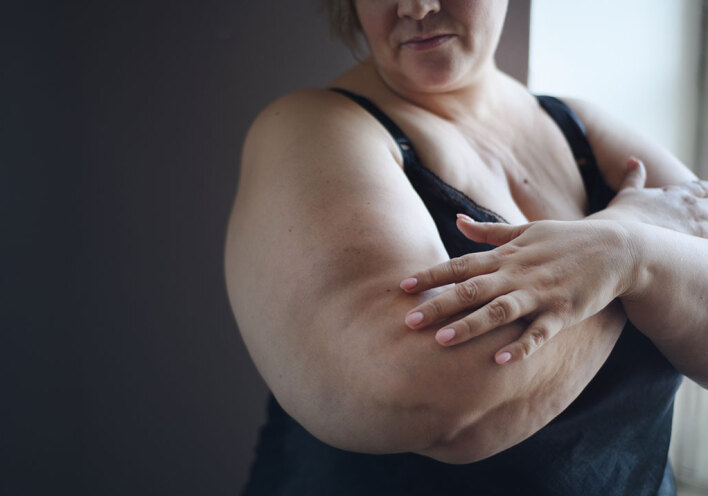 Παχύσαρκη γυναίκα