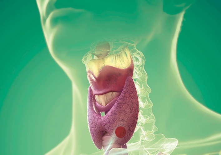 Όζοι θυρεοειδούς – 9 συχνές ερωτήσεις και απαντήσεις