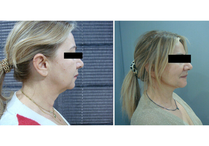 Deep Plane Face & Neck Lift
