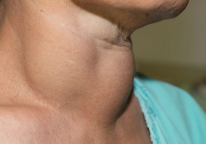 Βρογχοκήλη