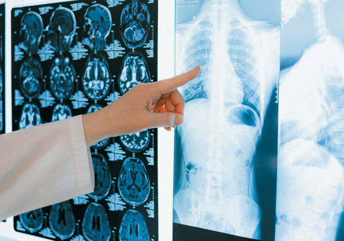 Ακτινογραφίες πνευμόνων