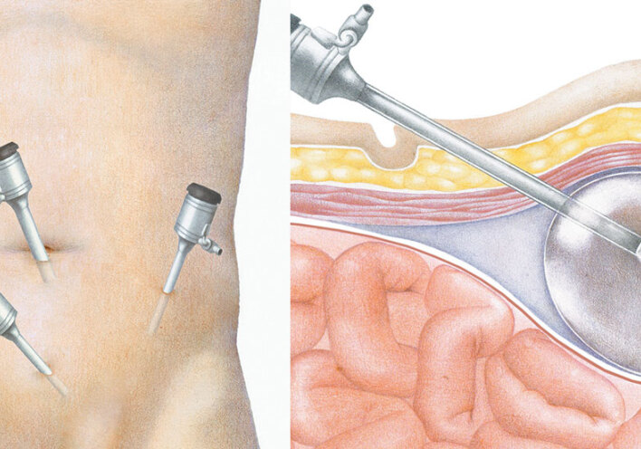 Εικονογράφηση λαπαροσκοπικής αντιμετώπισης της κήλης