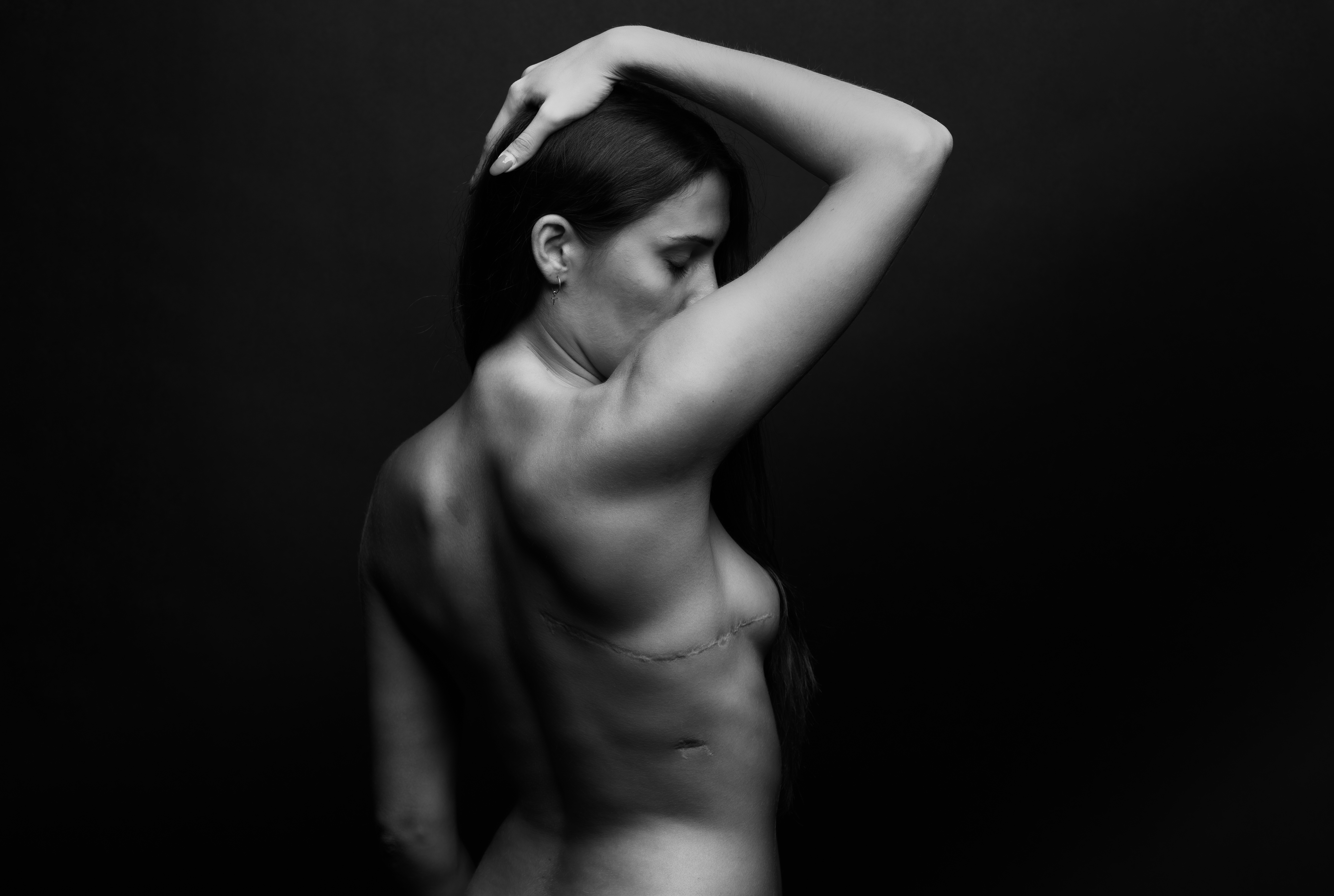 Ουλή από χειρουργείο πνεύμονα