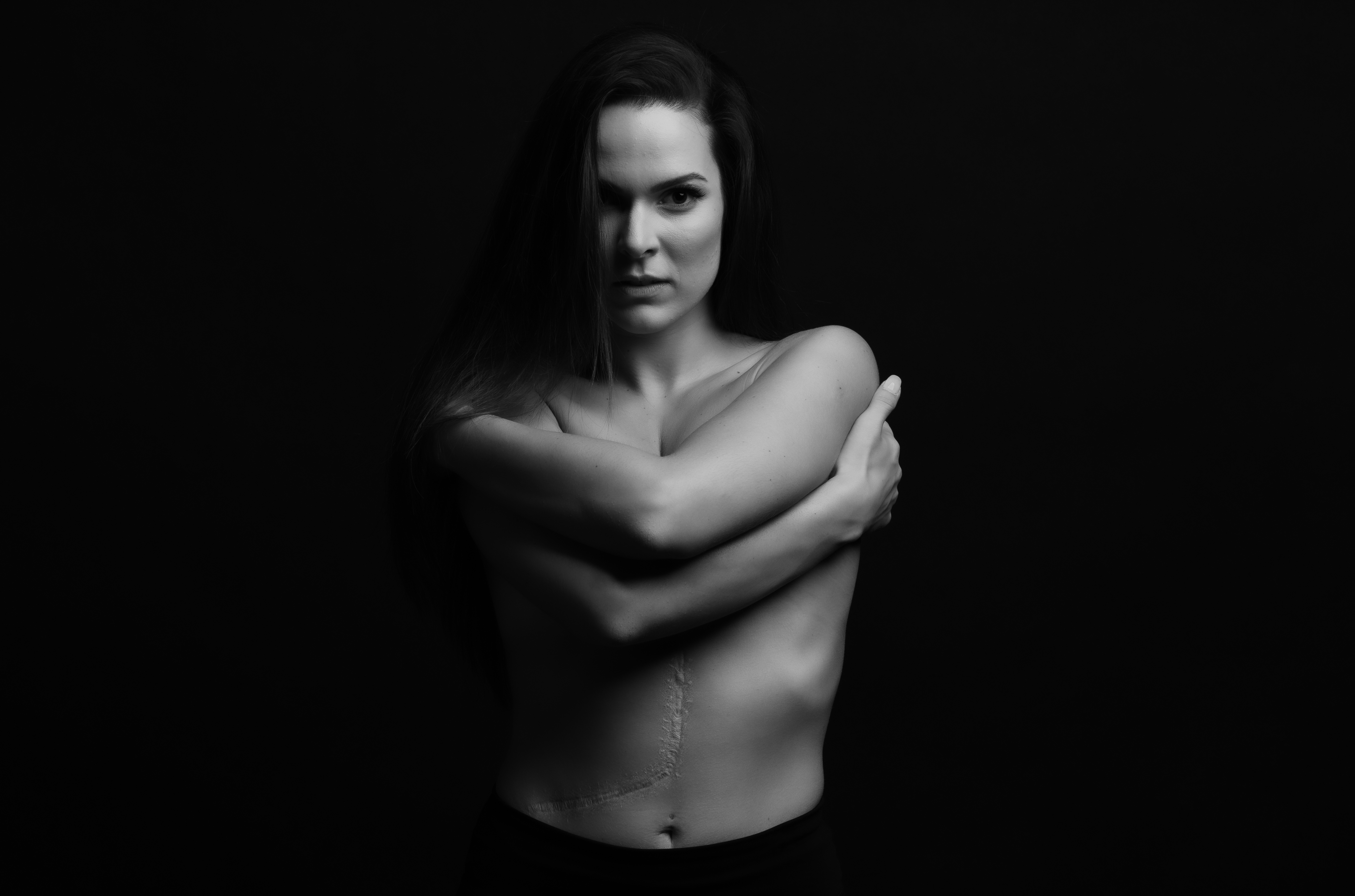 Ουλή από αφαίρεση των 3/4 του ήπατος και της χοληδόχου κύστης