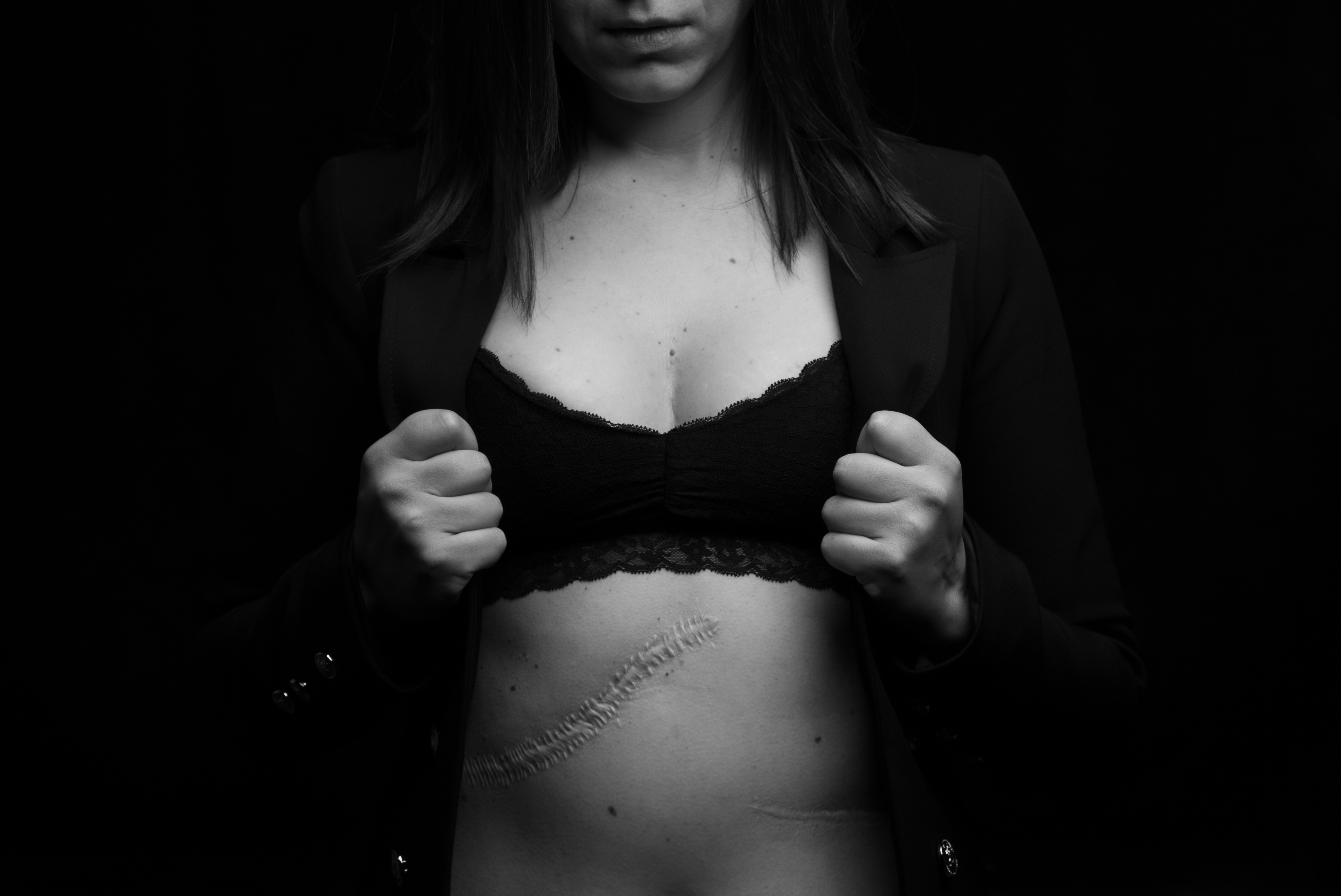 Ουλή από αφαίρεση καρκίνου νεφρού με μετάσταση στο ήπαρ