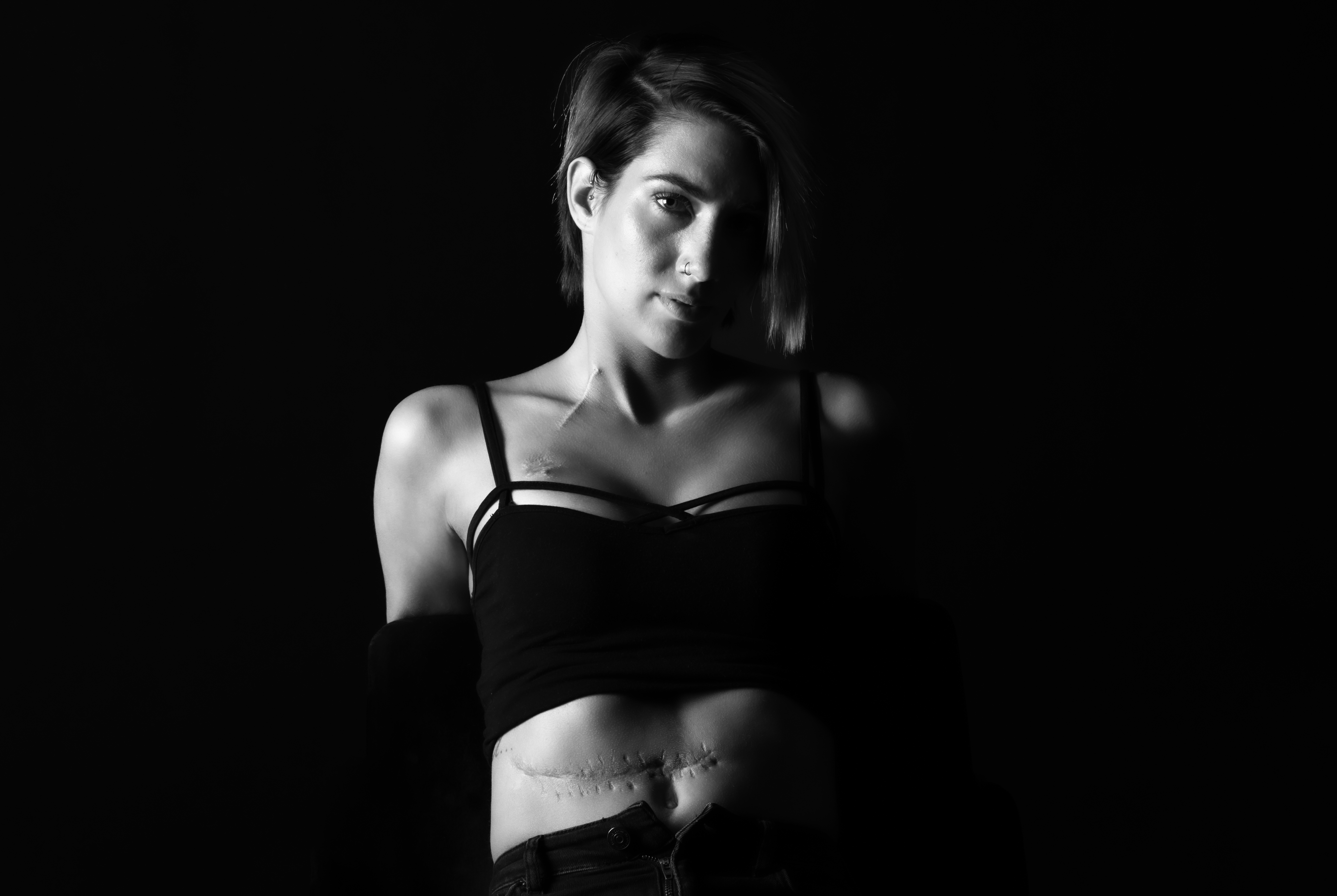 Ουλή από ειλεό