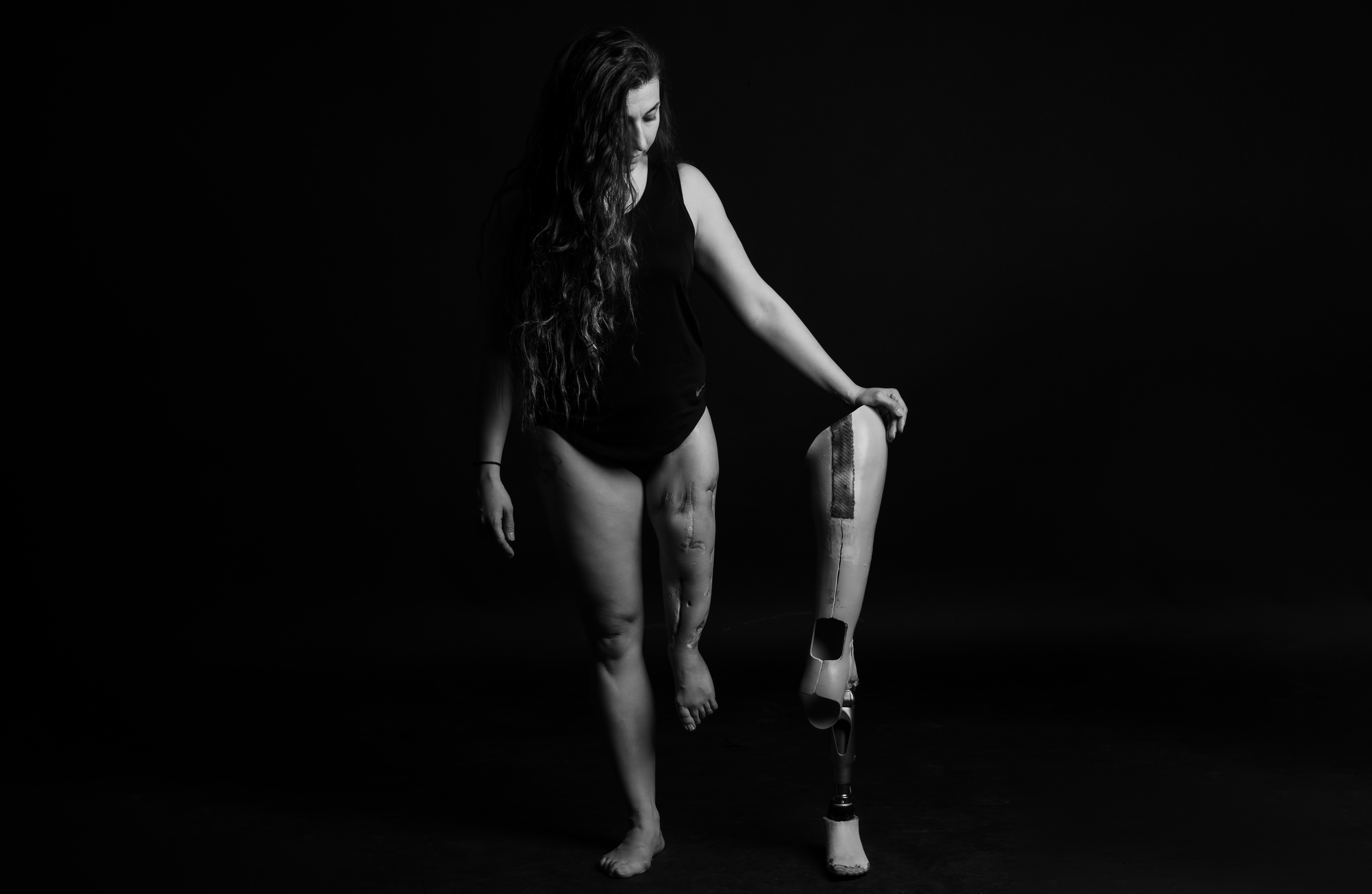 Ουλή από διόρθωση - αποκατάσταση οστού κάτω άκρου με Ilizarov