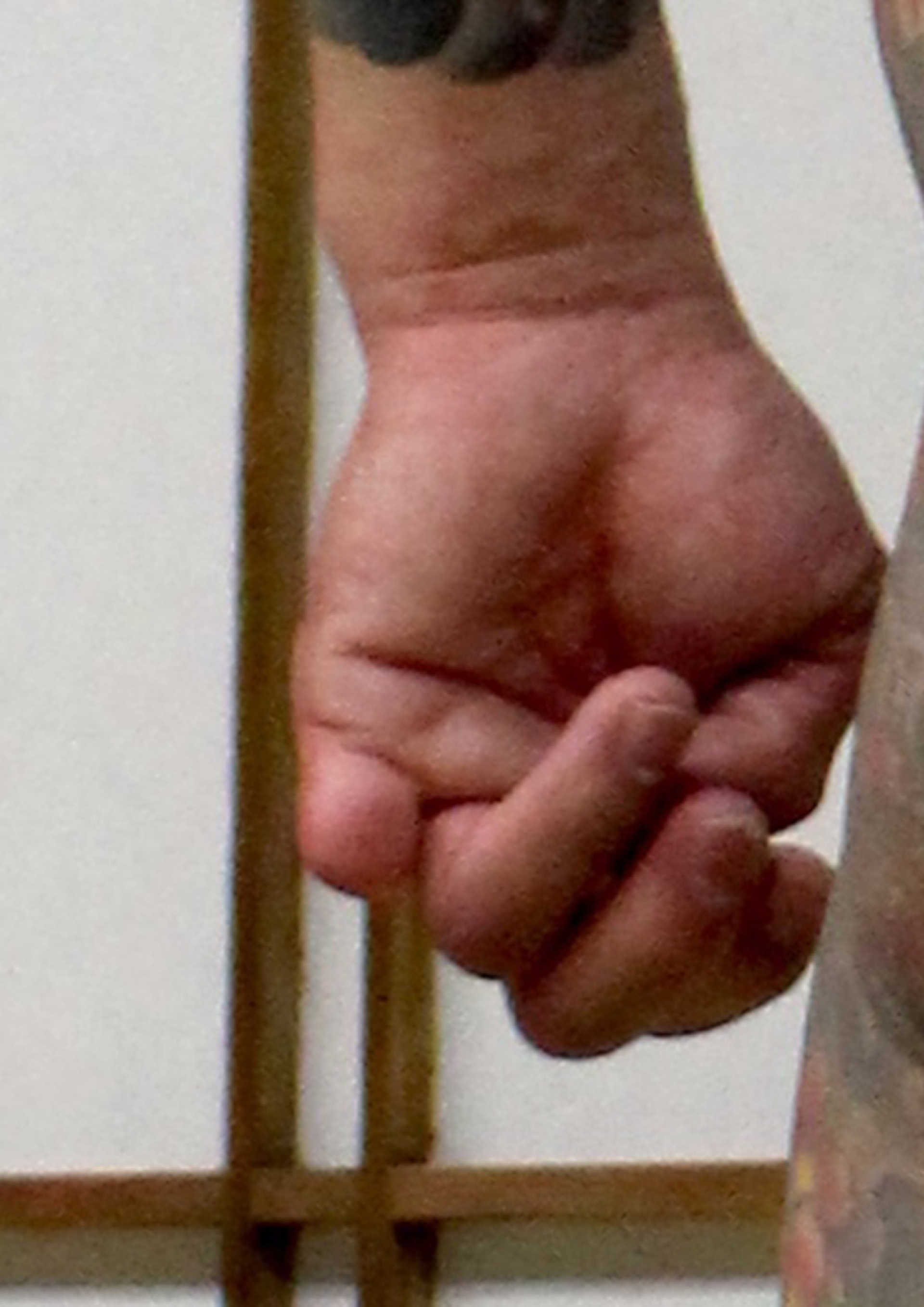 Yubitsume: Ακρωτηριασμός της φάλαγγας του μικρού δακτύλου