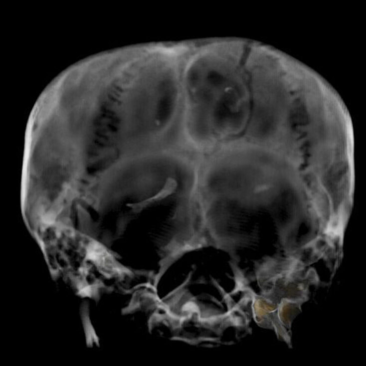 Ακτινογραφία του κεφαλιού της μούμιας του Τουταγχαμών