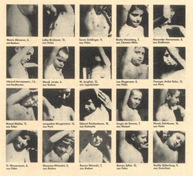 Τα 20 εβραιόπουλα που υποβλήθηκαν σε πείραμα και χειρουργική επέμβαση δείχνουν τις ουλές τους