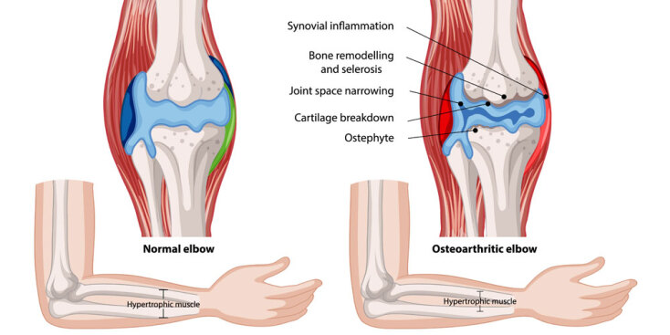 Οστεοαρθρίτιδα